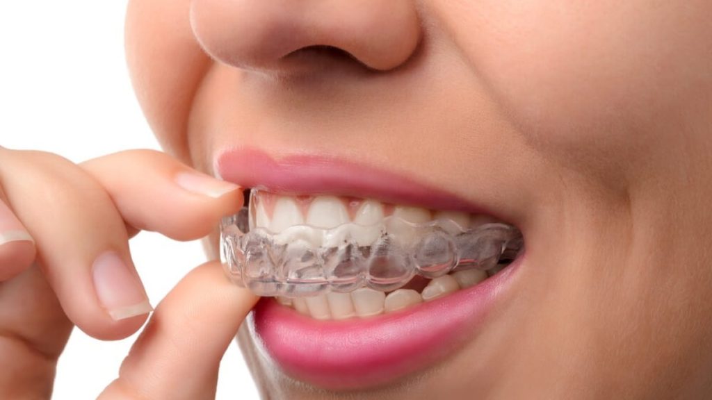Apparecchio trasparente per denti dritti: cos’è, come funziona e cosa sapere