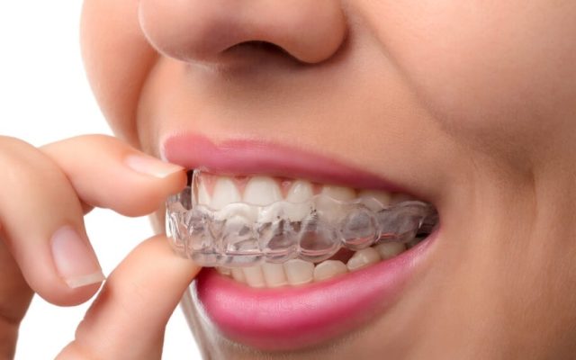 Apparecchio trasparente per denti dritti: cos’è, come funziona e cosa sapere