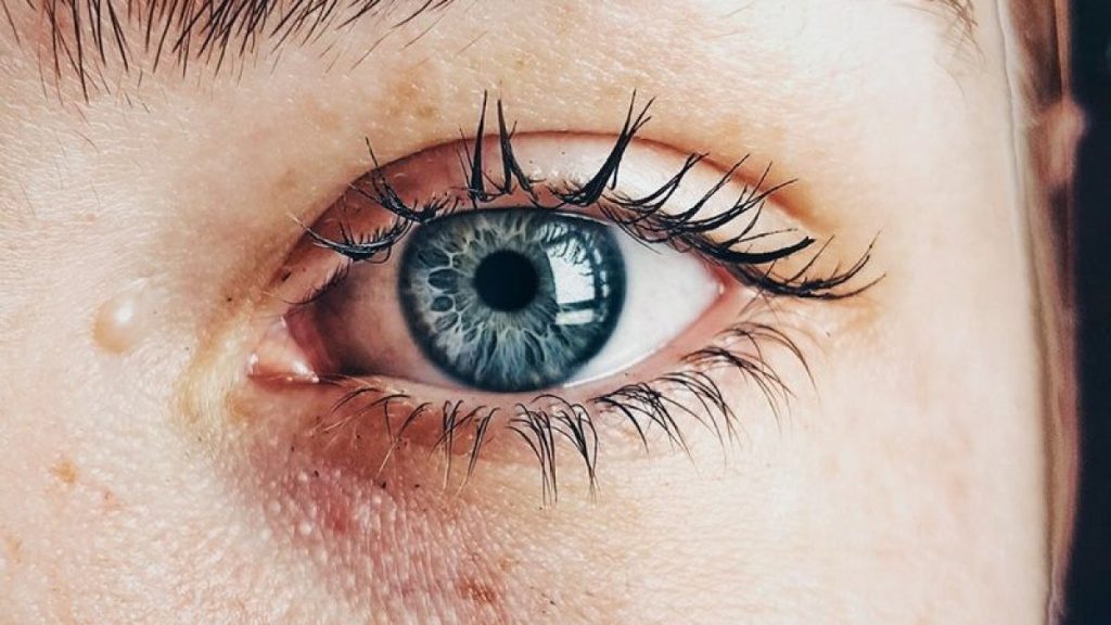 Perché vengono le occhiaie nerissime e cosa sapere sulle possibili cause